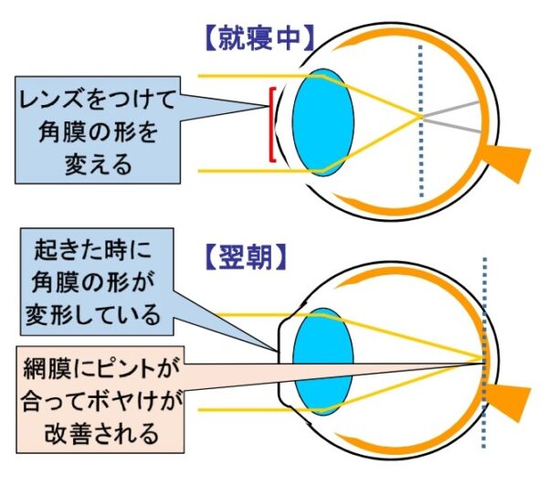 オルソケラトロジーの仕組み